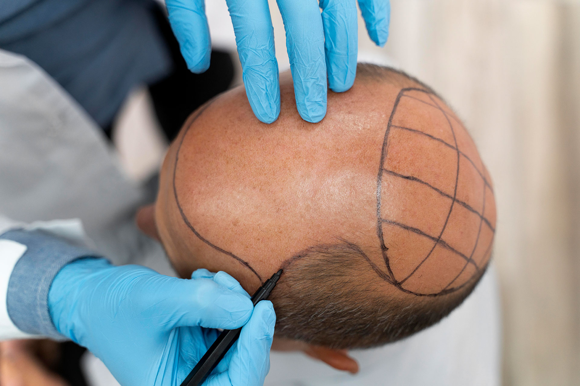 Hair Transplant in Turkey