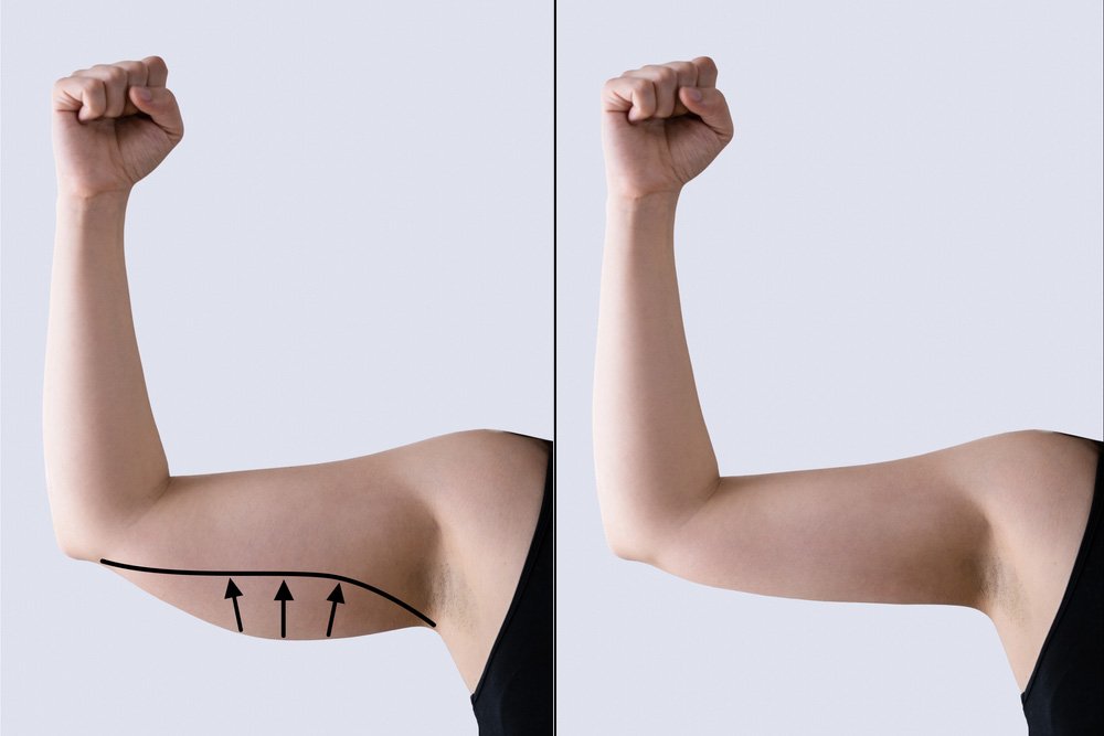 Arm Liposuction