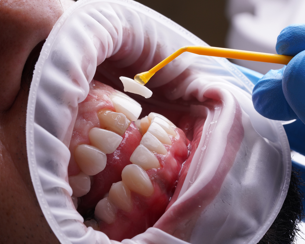Dental Veneers in Turkey