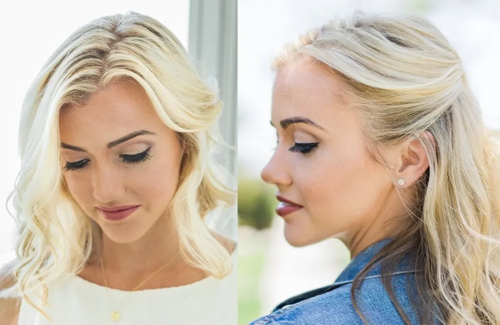Female Hair Transplantation in Turkey