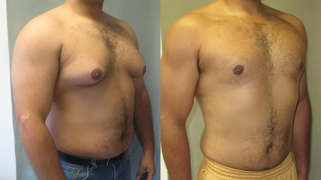 Gynecomastia Surgery
