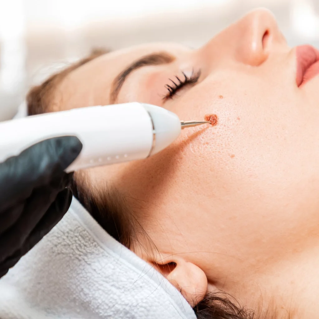 Mole Removal in Turkey