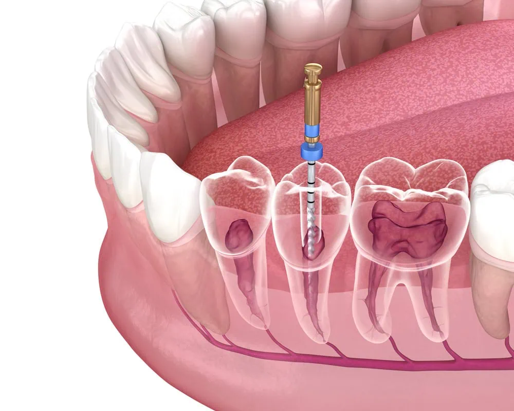 Root Canal Treatment in Turkey