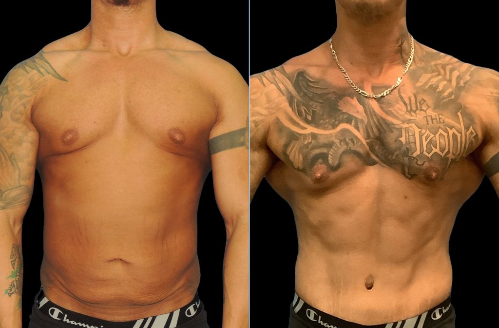 Vaser High-Definition Liposuction in Turkey