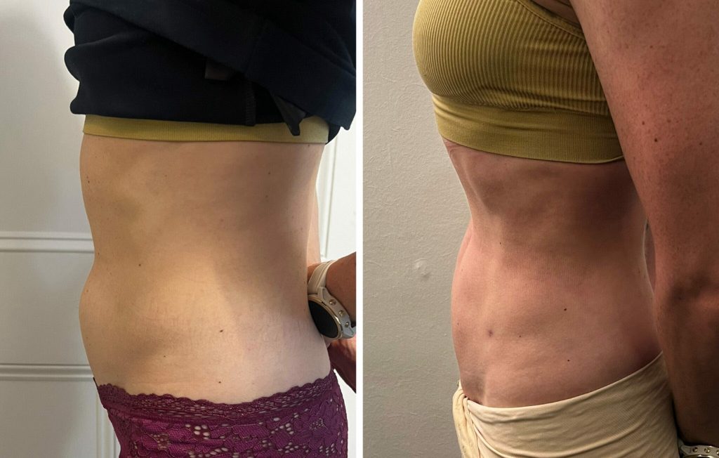 Vaser Liposuction in Turkey