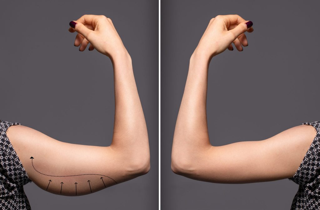 arm lift aesthetics