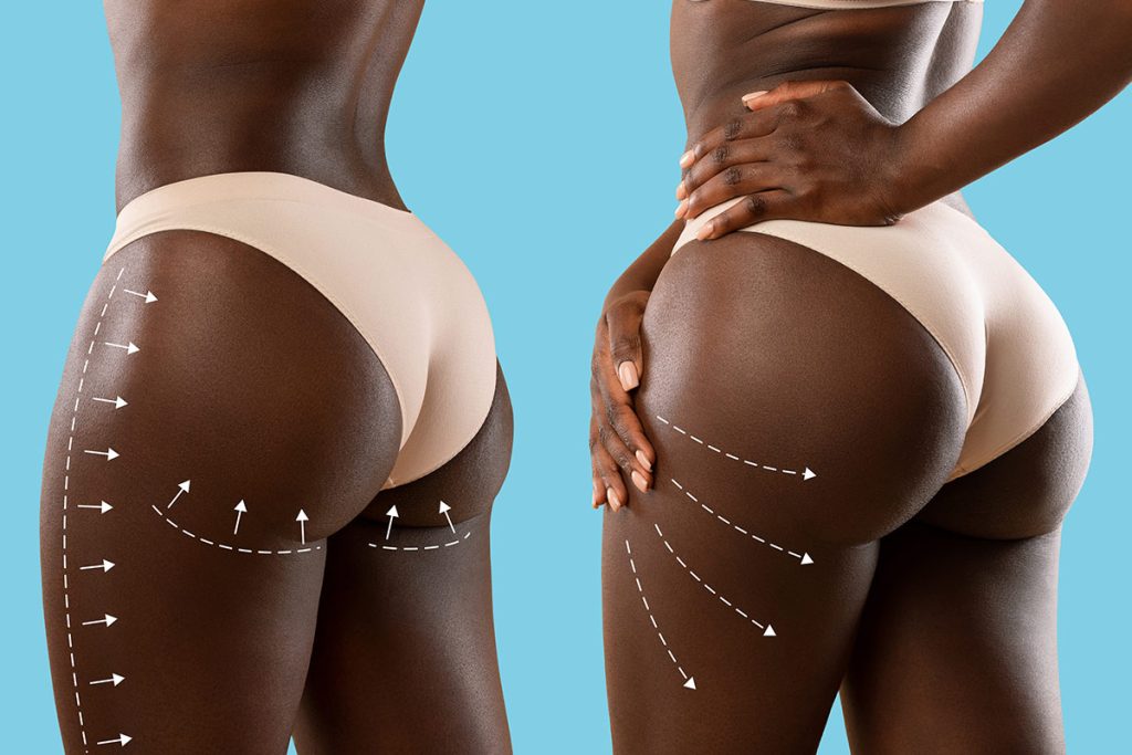 Brazilian Butt Lift BBL Surgery