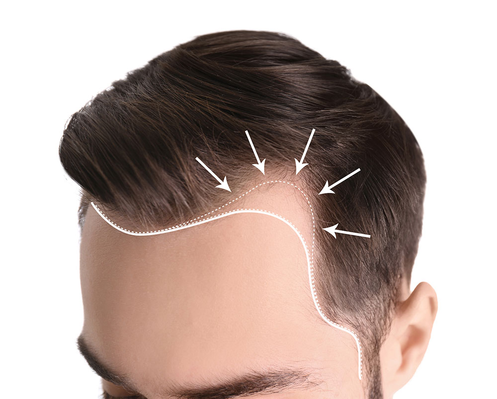 Hair Transplant in Turkey