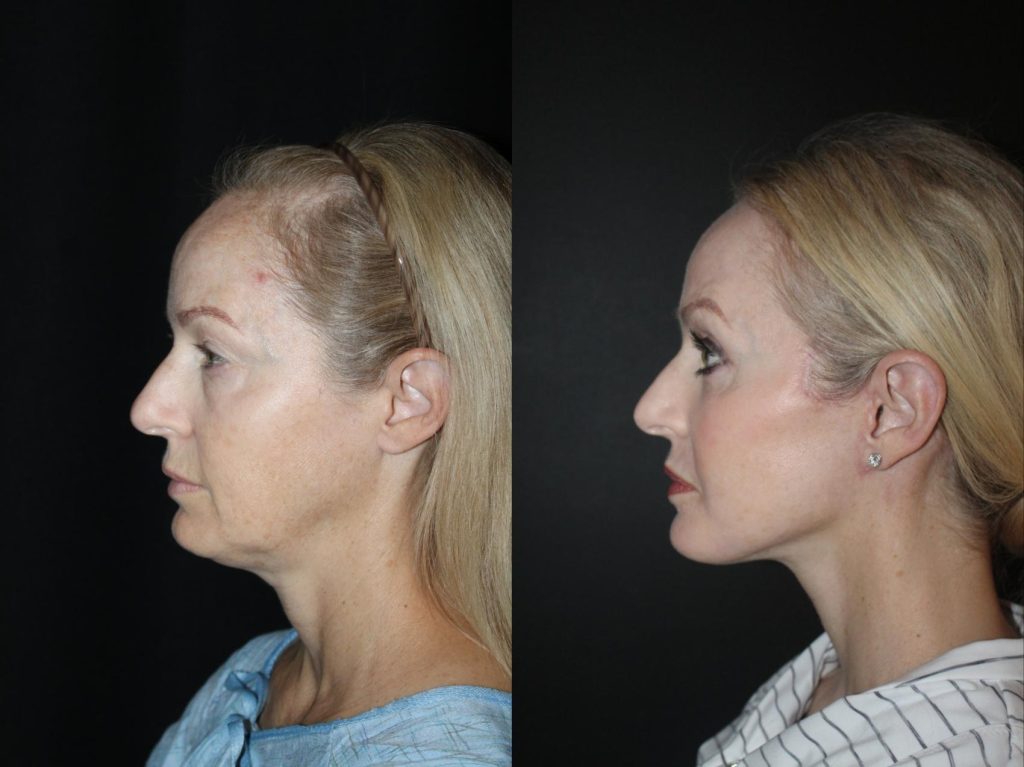 Neck Lift in Turkey