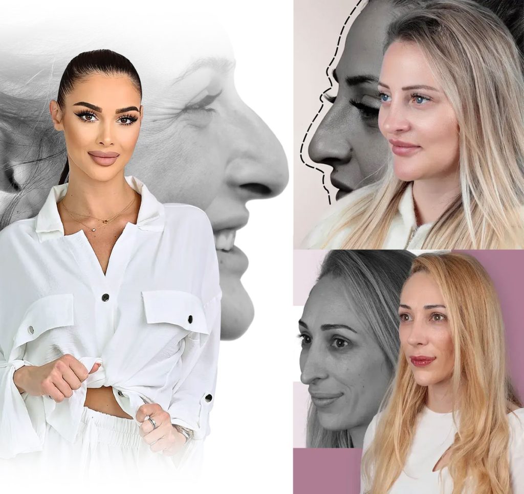 Rhinoplasty in Turkey