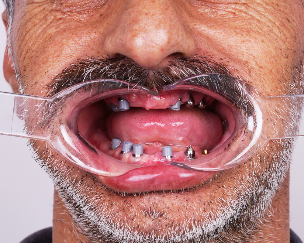Dental Implants in Turkey