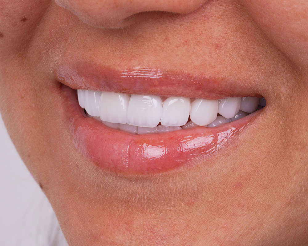 Dental Treatments in Turkey