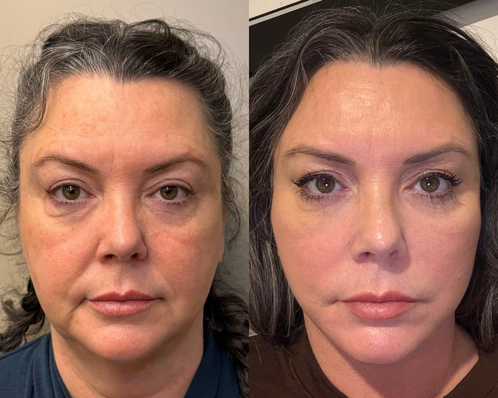 Face Lift in Turkey