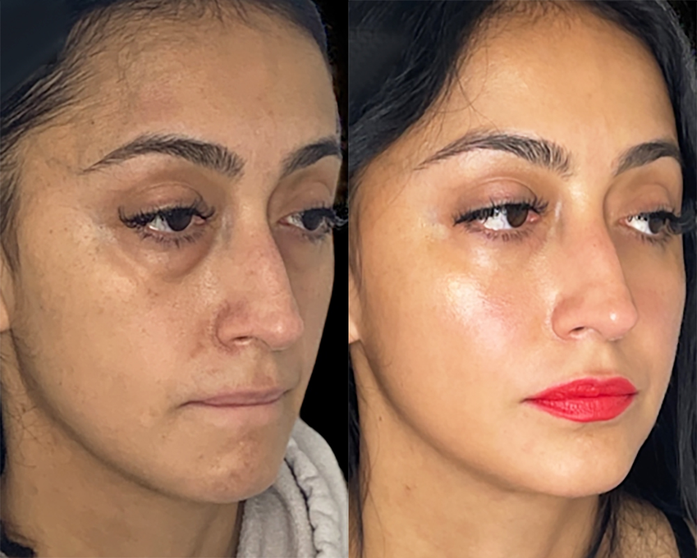 Facial Fat Injection in Turkey