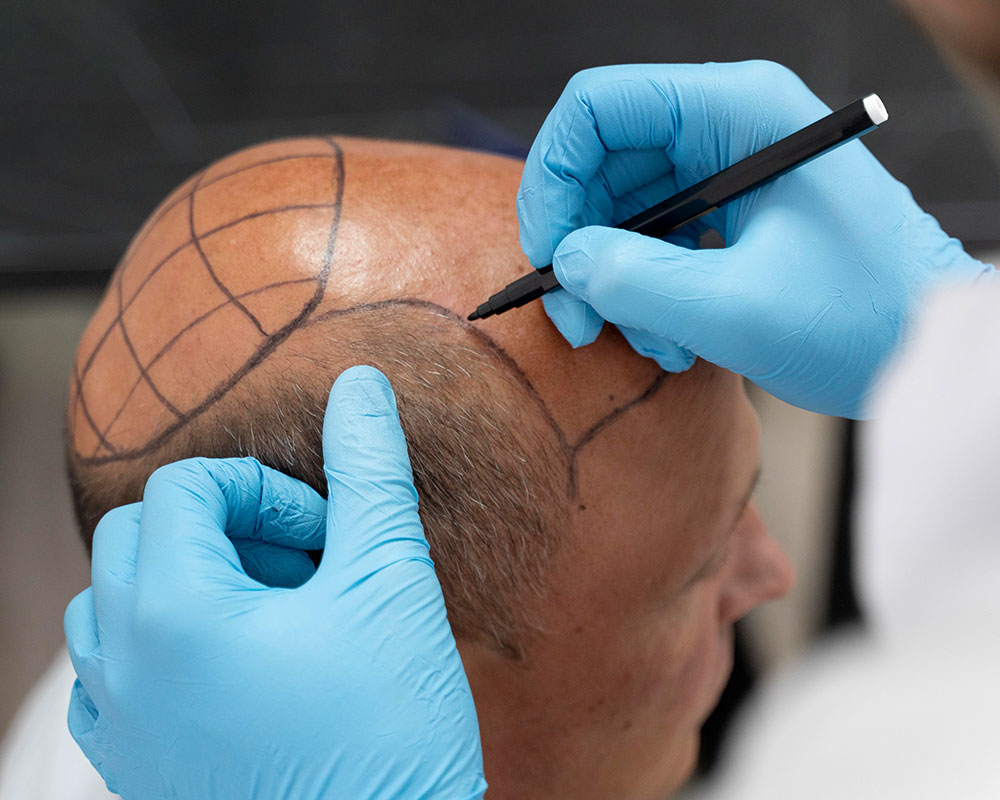 Hair Transplantation in Turkey