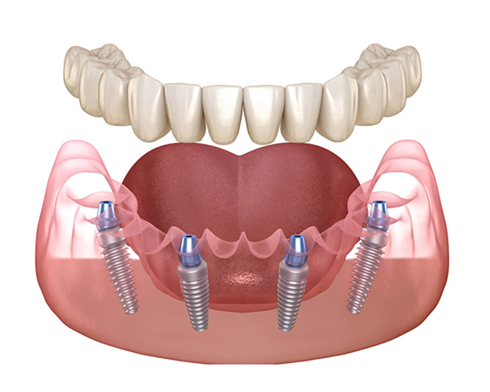 All-on-4 Dental Implants in Turkey