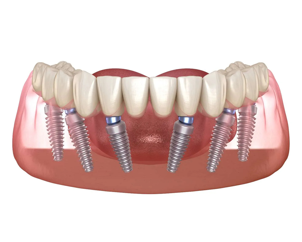 All-on-6 Dental Implants in Turkey