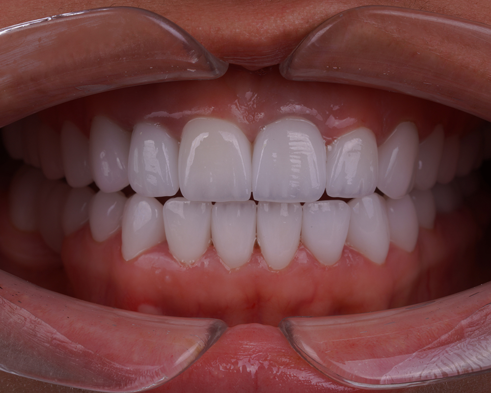 Full Set of Emax Veneers Turkey