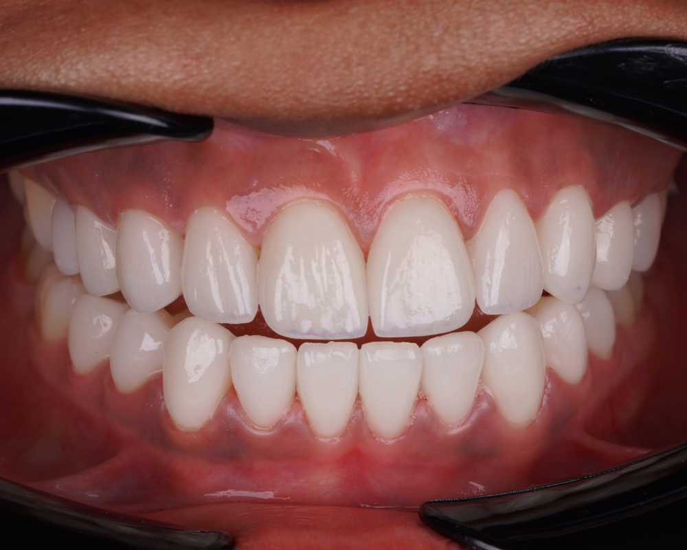 Full Set of Veneers in Turkey